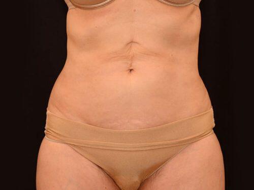 CoolSculpting  Before & After Image