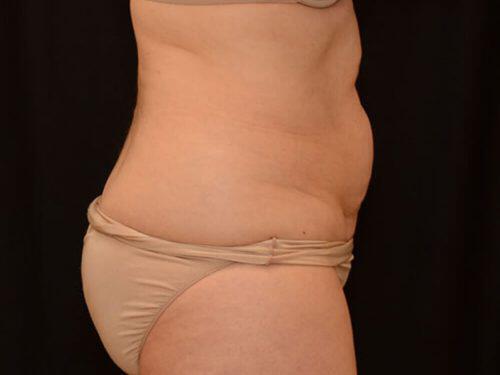 CoolSculpting  Before & After Image