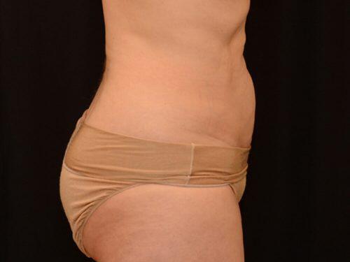 CoolSculpting  Before & After Image