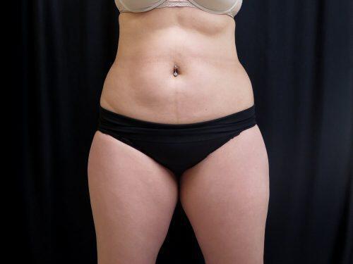 CoolSculpting  Before & After Image