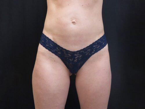 CoolSculpting  Before & After Image