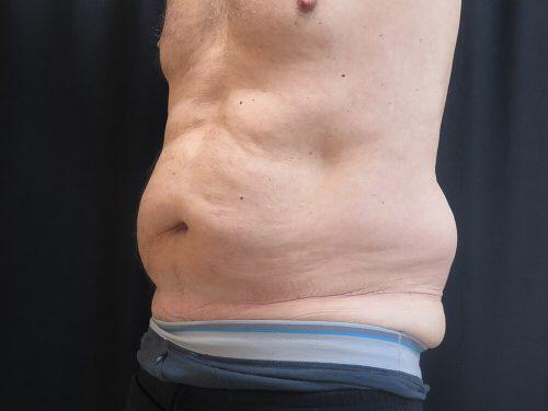 CoolSculpting  Before & After Image