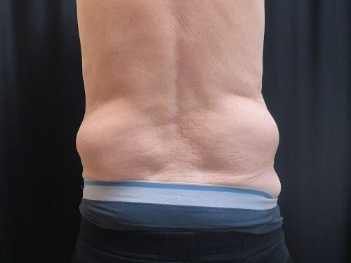 CoolSculpting  Before & After Image