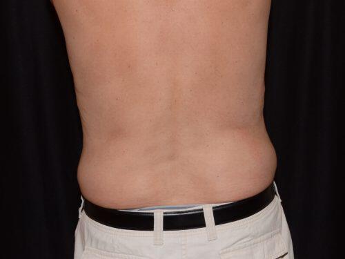 CoolSculpting  Before & After Image