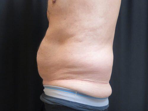 CoolSculpting  Before & After Image