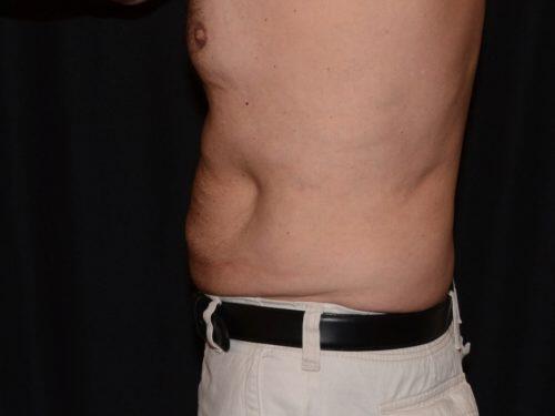 CoolSculpting  Before & After Image