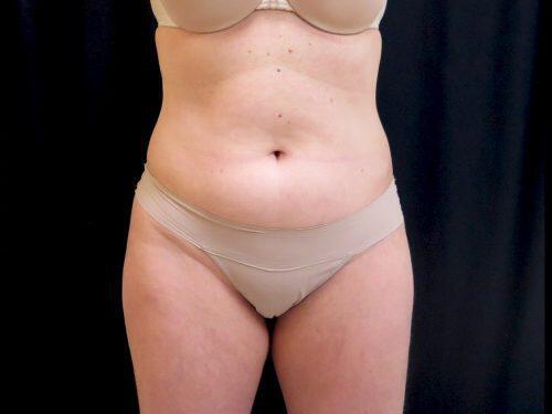 CoolSculpting  Before & After Image