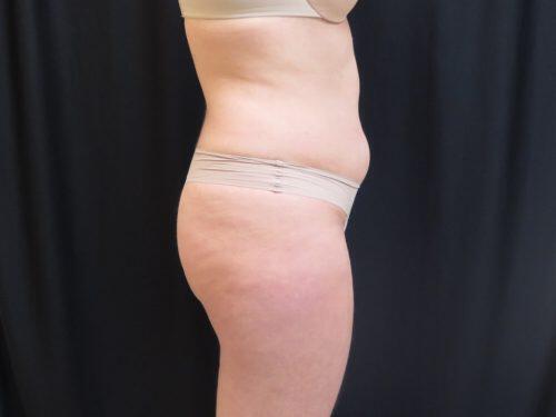 CoolSculpting  Before & After Image