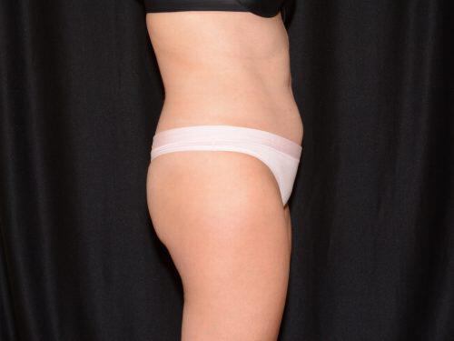 CoolSculpting  Before & After Image