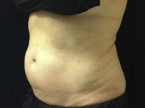 CoolSculpting  Before & After Image