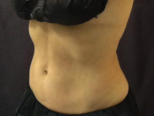CoolSculpting  Before & After Image