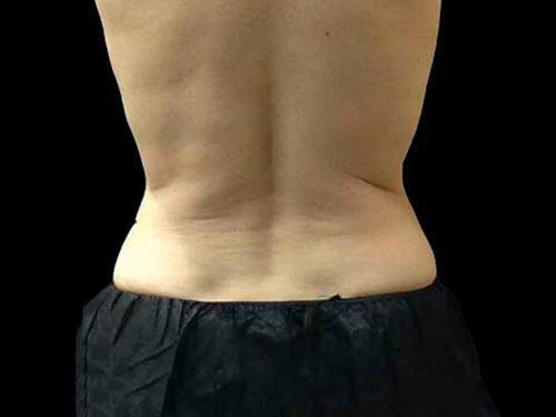 CoolSculpting  Before & After Image