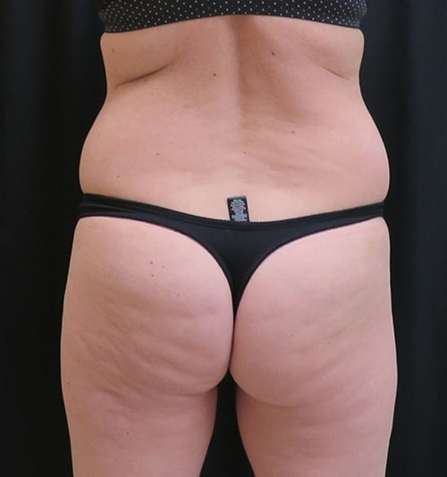 CoolSculpting  Before & After Image