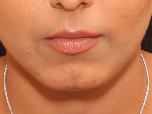 Dermal Fillers Before & After Image