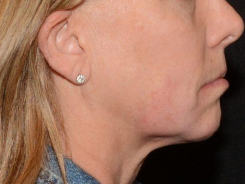 Dermal Fillers Before & After Image