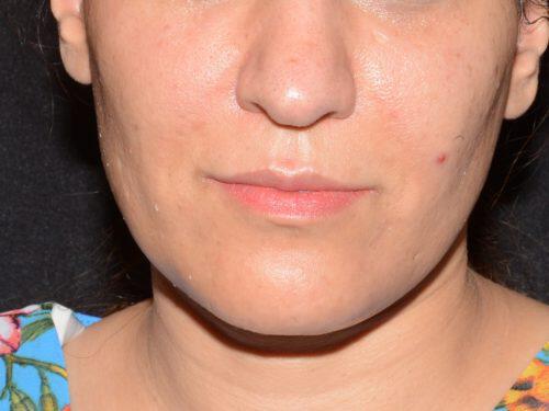 Dermal Fillers Before & After Image