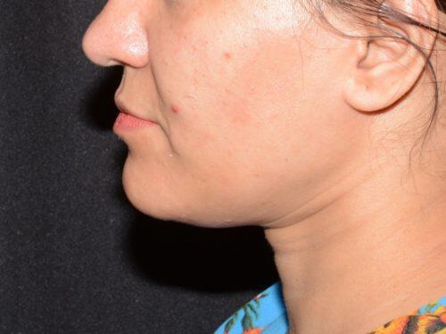 Dermal Fillers Before & After Image