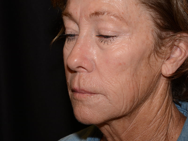 Dermal Fillers Before & After Image