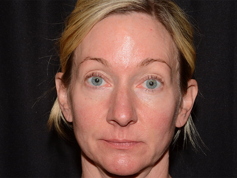 Dermal Fillers Before & After Image