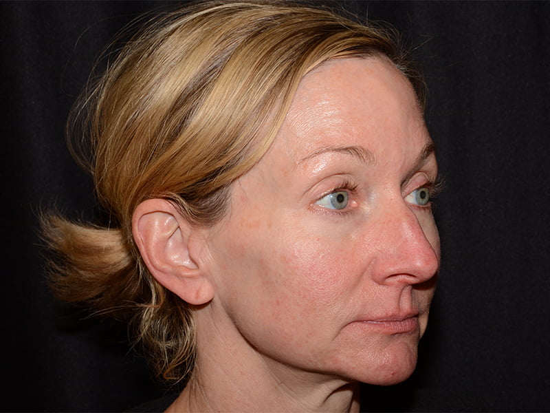 Dermal Fillers Before & After Image