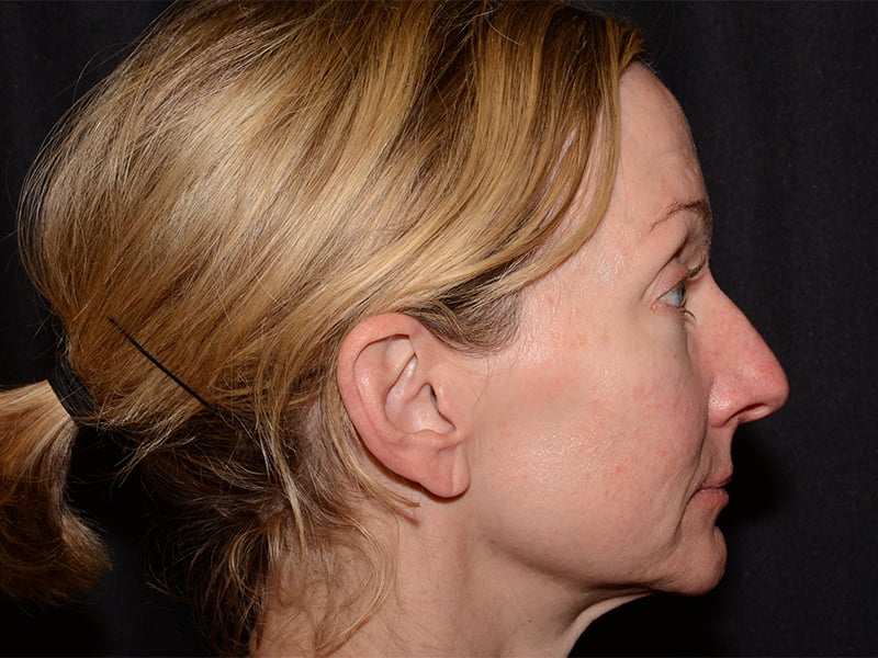 Dermal Fillers Before & After Image