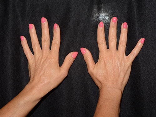 Hand Rejuvenation Before & After Image