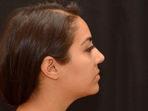Kybella  Before & After Image