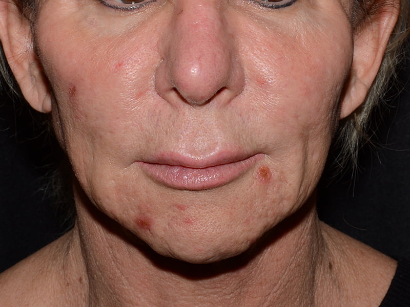 Lip Lift Before & After Image