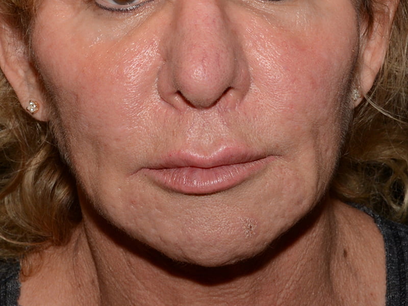 Lip Lift Before & After Image