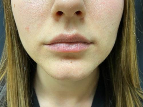 Lip Filler Before & After Image