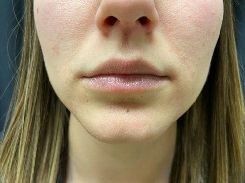 Lip Filler Before & After Image