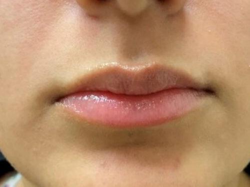 Lip Filler Before & After Image