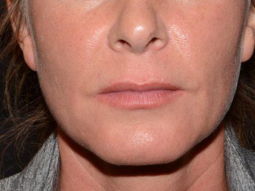 Lip Filler Before & After Image