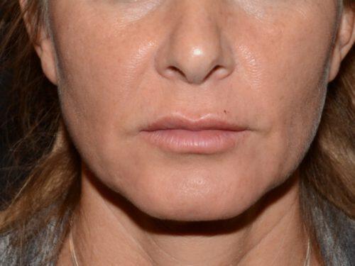 Lip Filler Before & After Image