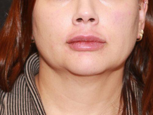 Lip Filler Before & After Image