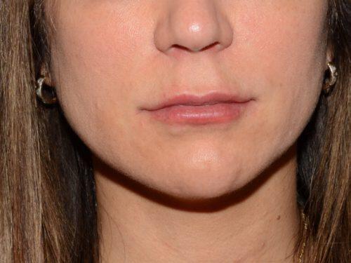 Lip Filler Before & After Image