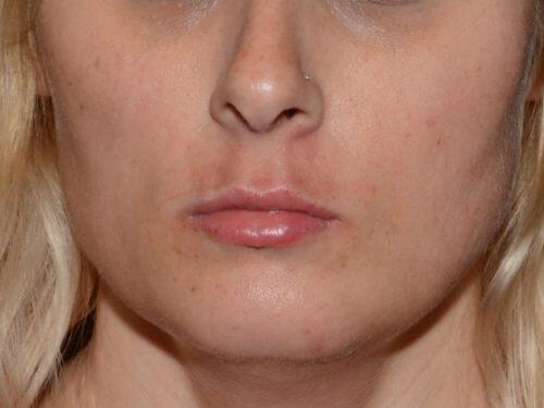 Lip Filler Before & After Image