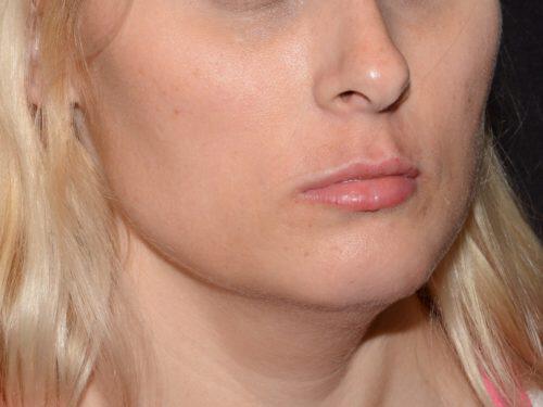 Lip Filler Before & After Image