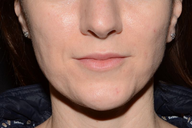 Lip Filler Before & After Image