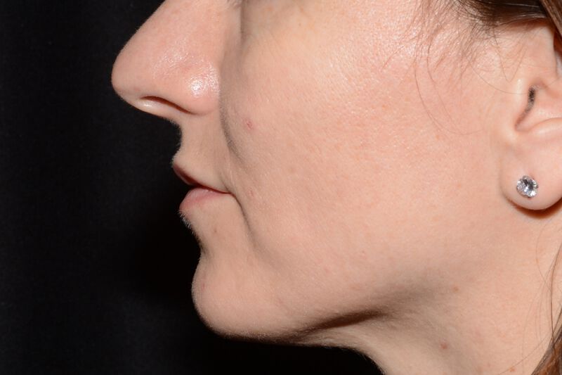 Lip Filler Before & After Image