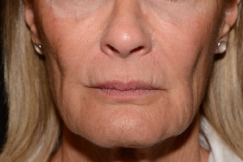 Lip Filler Before & After Image