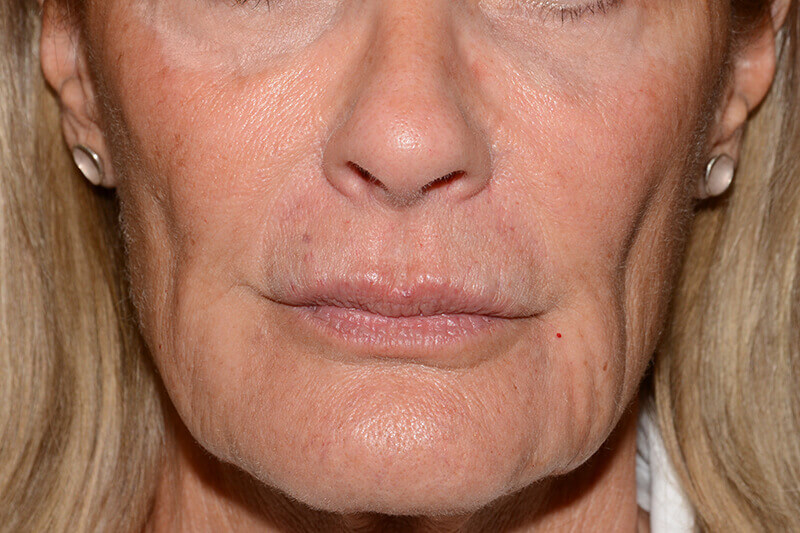 Lip Filler Before & After Image