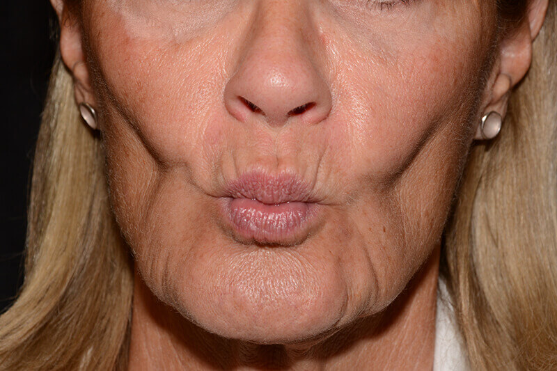 Lip Filler Before & After Image