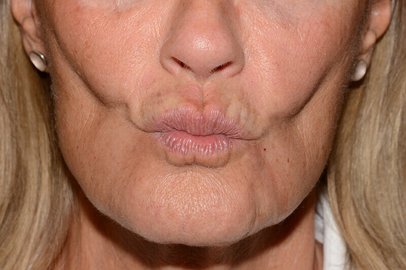 Lip Filler Before & After Image