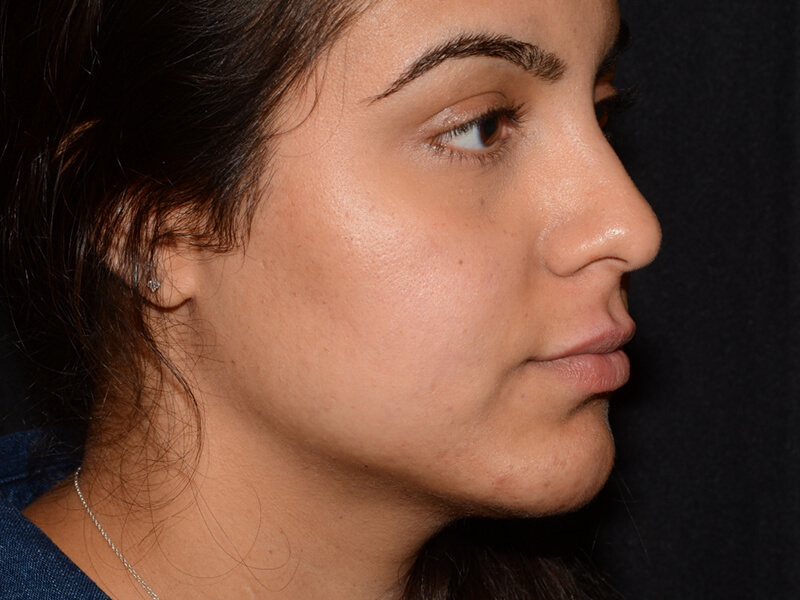 Lip Filler Before & After Image