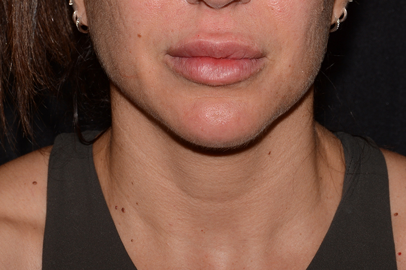 Lip Filler Before & After Image