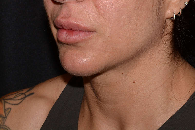 Lip Filler Before & After Image