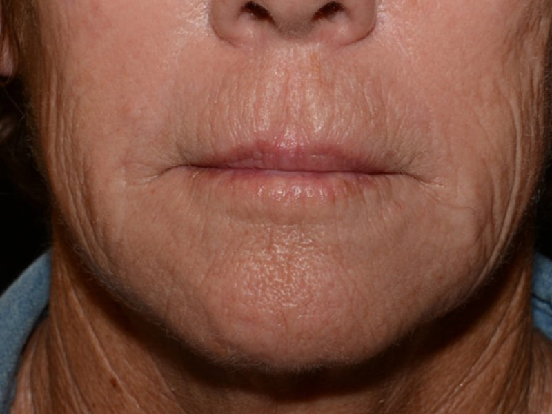 Lip Filler Before & After Image