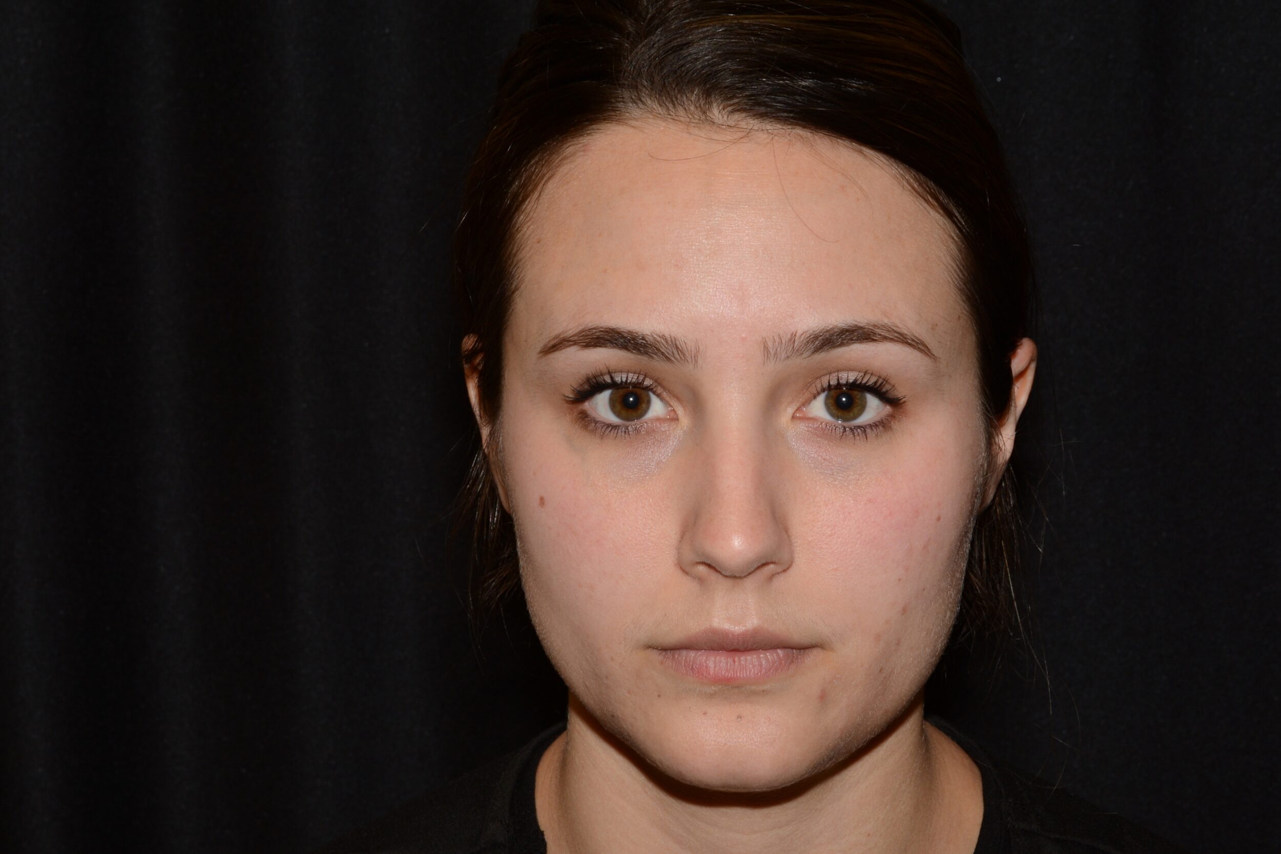 Before Image: Eleven’s Forehead - front