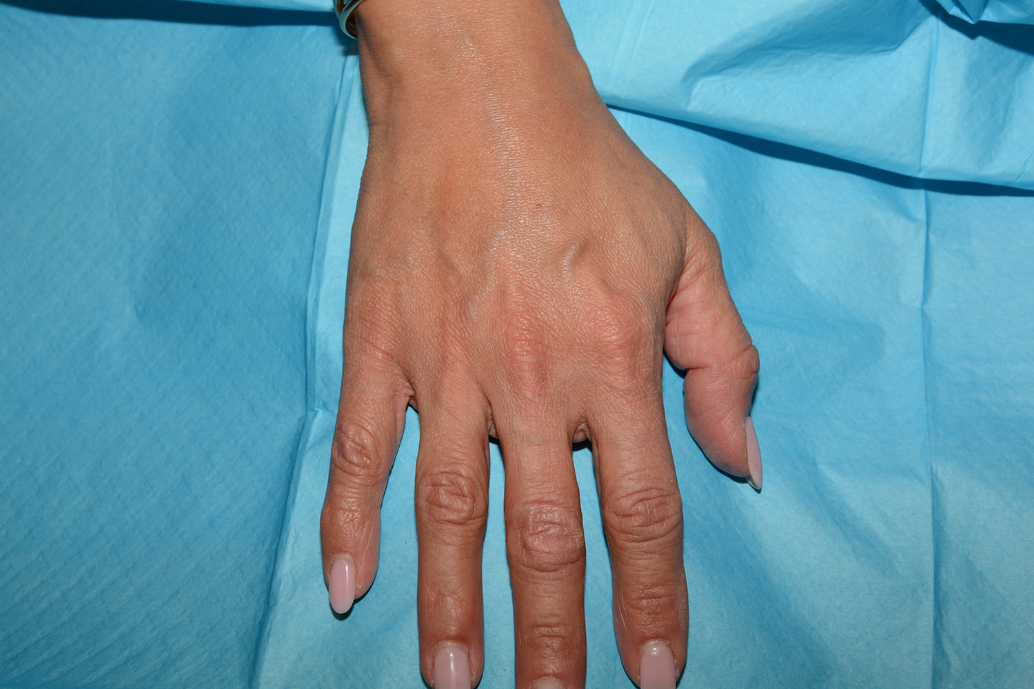After Image: Hand Rejuvenation - front